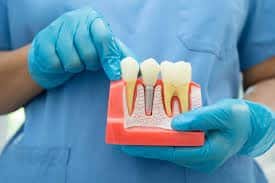Choosing the Right Dental Implant