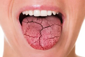 Understanding Dry Mouth: Symptoms, Causes, and Remedies