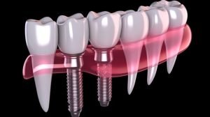How Dental Implants Work and Last a Lifetime