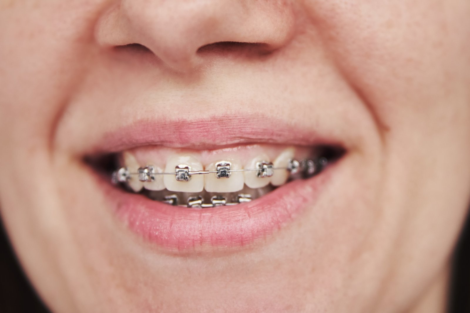 Woman with braces on teeth, closeup