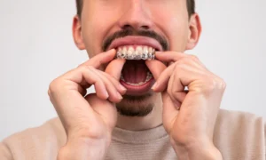 Invisalign in Nottingham City Centre: Straight Teeth Around Your Schedule