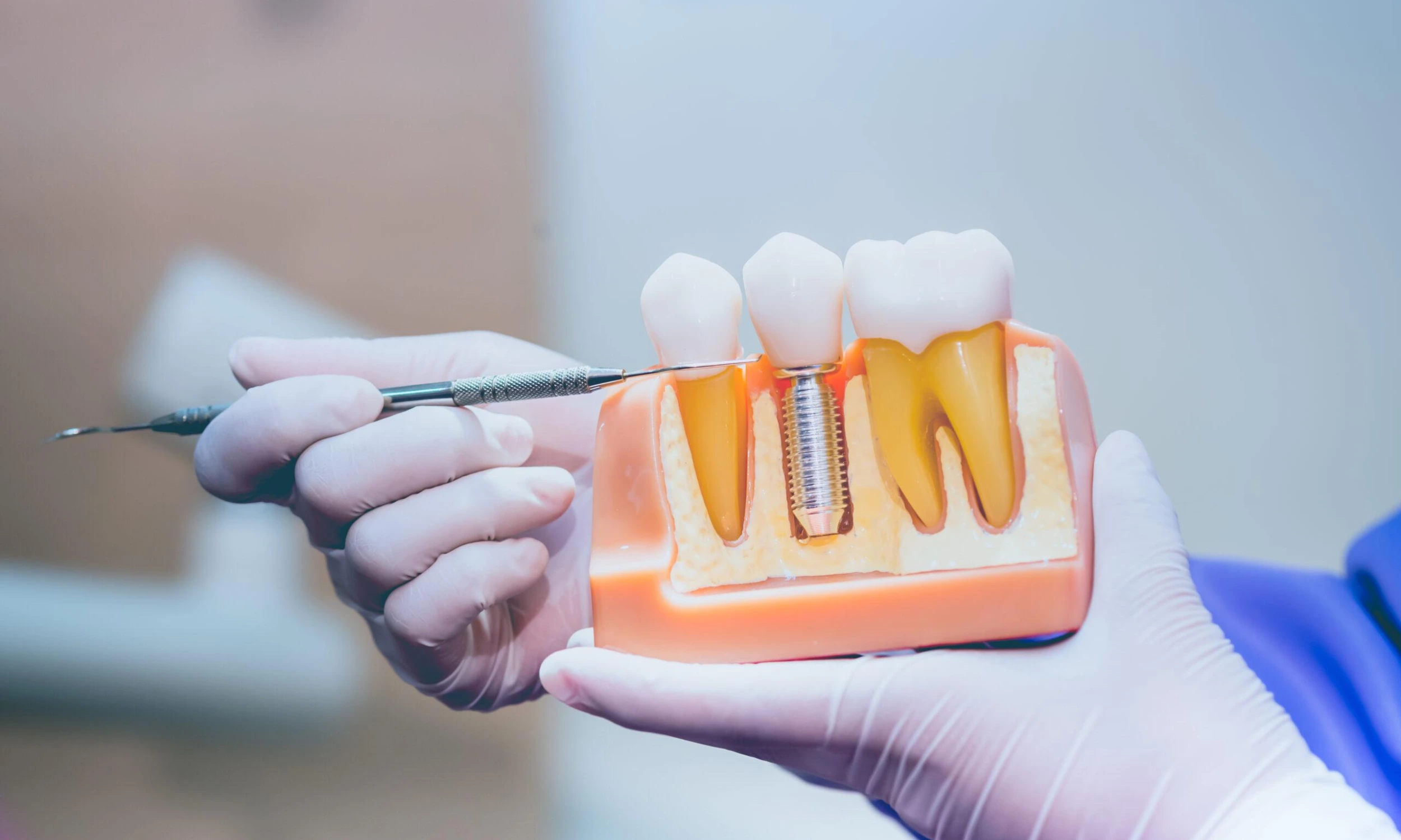 Dental Implants Near Bolsover