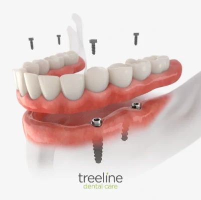 All-on-4 dental implants at Treeline Dental – East Midlands, UK All-on-4 dental implants at Treeline Dental - East Midlands, UK