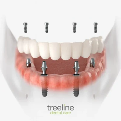 Full Mouth dental implants at Treeline Dental – East Midlands, UK Full Mouth dental implants at Treeline Dental - East Midlands, UK
