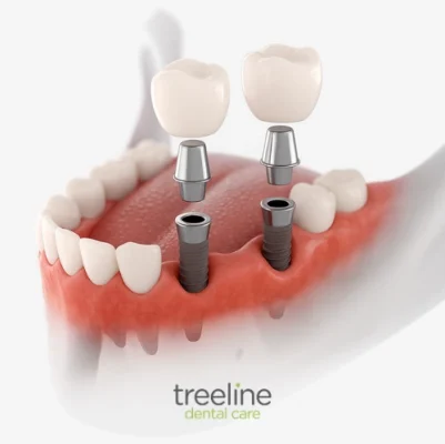 Multiple dental implants at Treeline Dental – East Midlands, UK Multiple dental implants at Treeline Dental - East Midlands, UK