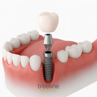Single implant at Treeline Dental – East Midlands, UK Single implant at Treeline Dental - East Midlands, UK